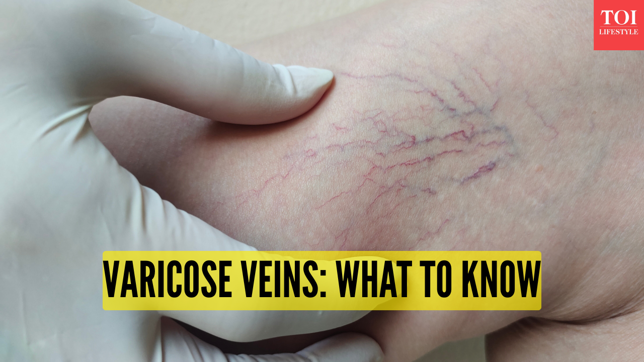 From heavy legs to twisted veins: 5 early varicose vein symptoms one should not ignore