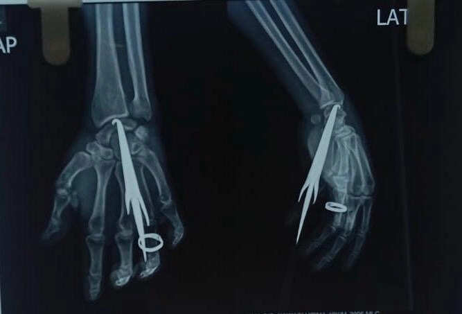 Son attacks man with arrows, critical surgery saves life in Bastar