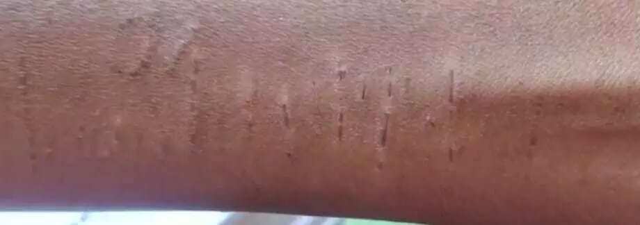 Chhattisgarh shocker: Mass wrist-cutting by 35 schoolkids, probe flags &lsquo;imitation' trend; Counsellors on job