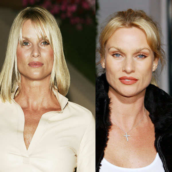 Stars Before & After Cosmetic Surgeries