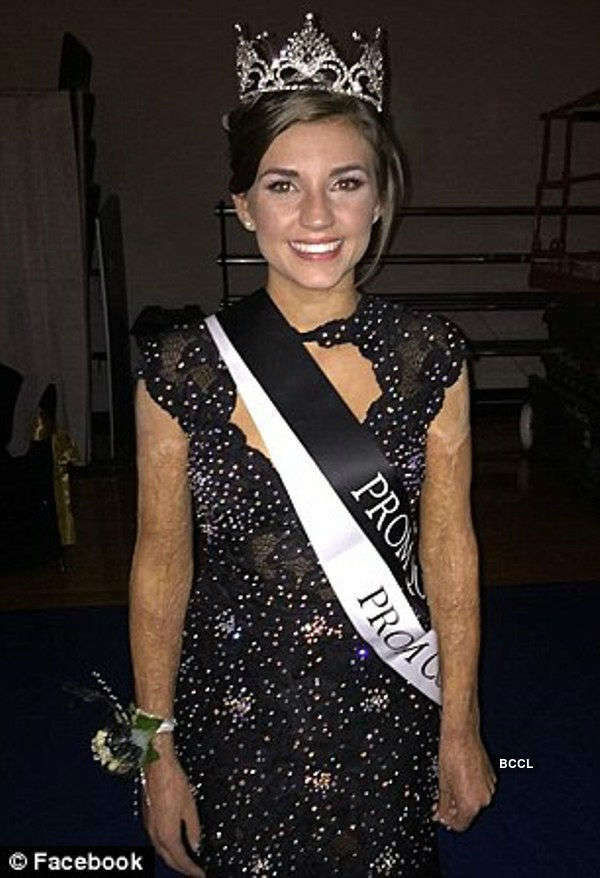 Teen who was burned crowned prom queen