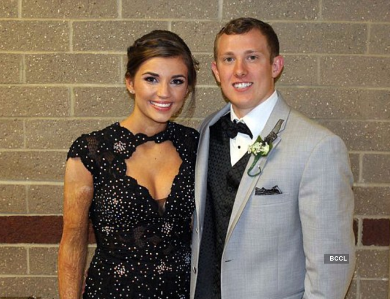 Teen who was burned crowned prom queen