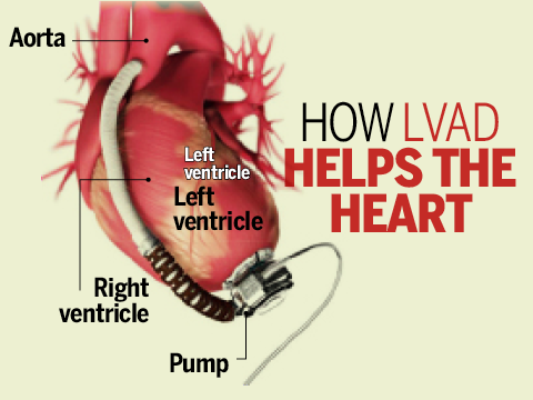 Infographic: What is LVAD and how it works - Times of India