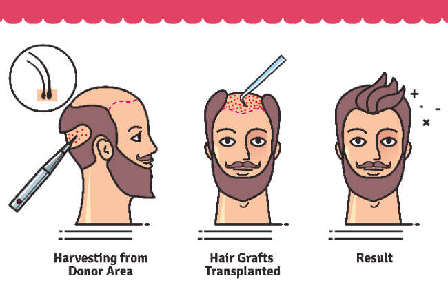 hair  transplant procedue