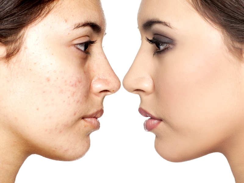 5 Best Ways To Remove Blemishes Naturally The Times Of India