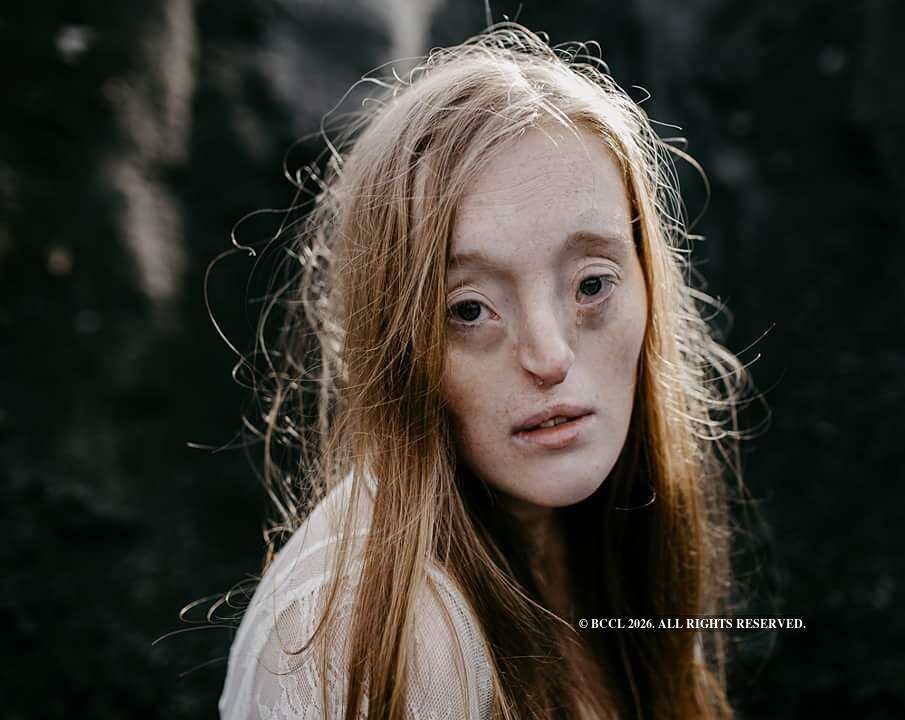 Model born with a facial cleft is shattering beauty norms