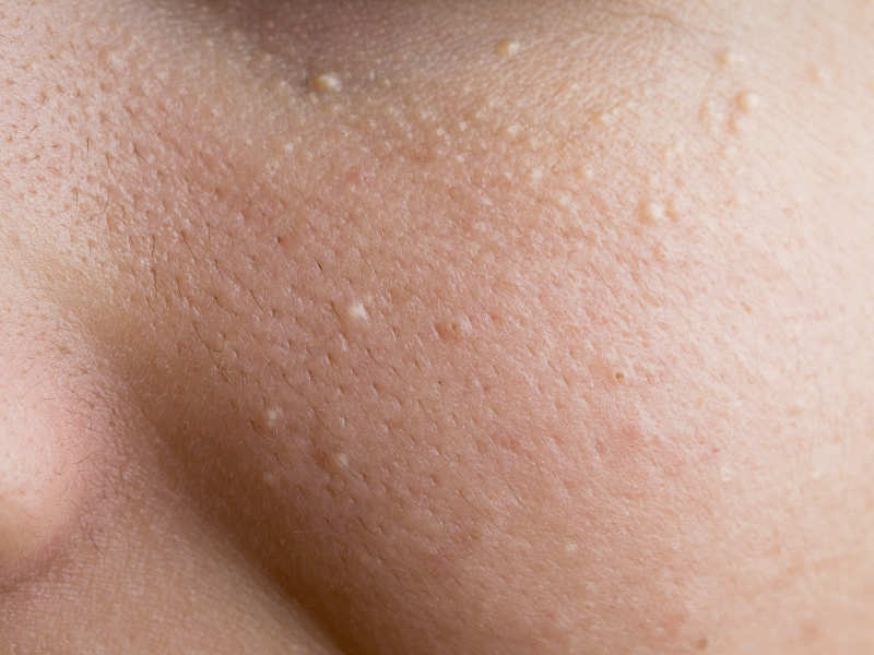The White Bumps On The Face Are Not Acne