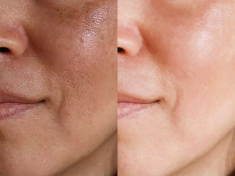 What can treat large facial pores?