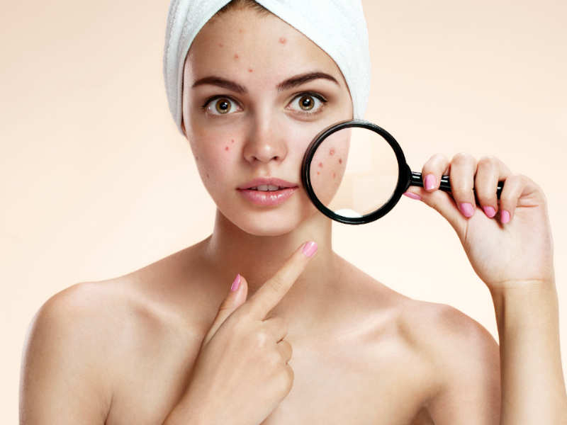 How To Treat Dark Spots At Home The Times Of India