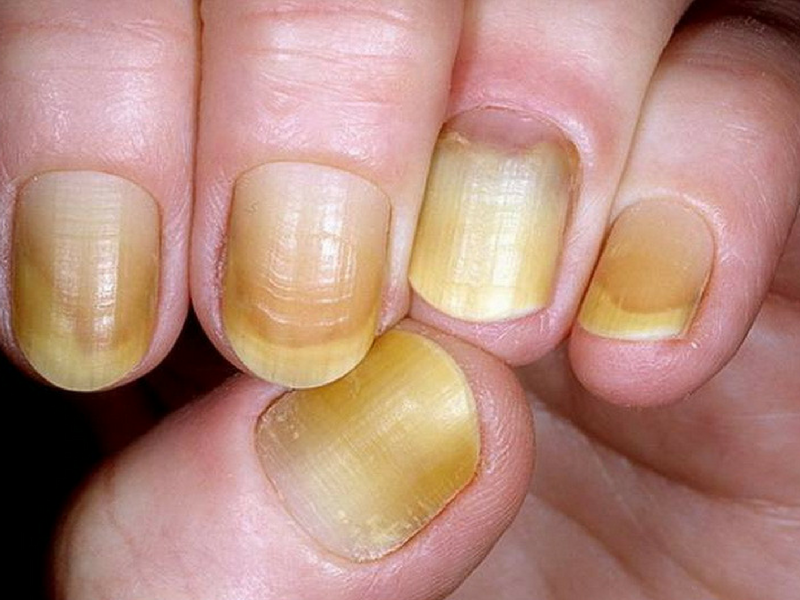 Broken or yellow nails? 7 warning signs your nails are trying to ...