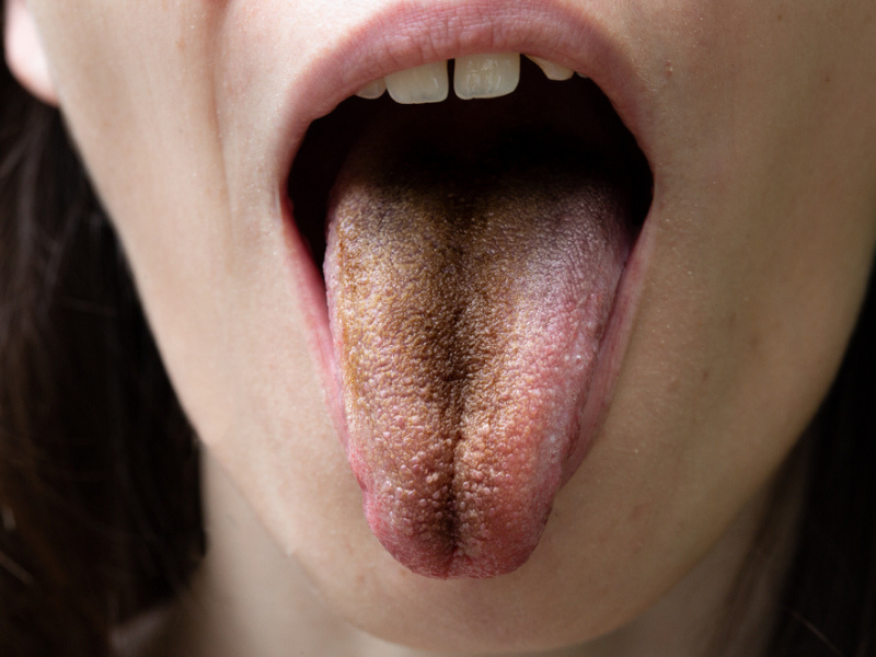 ​​Brown tongue