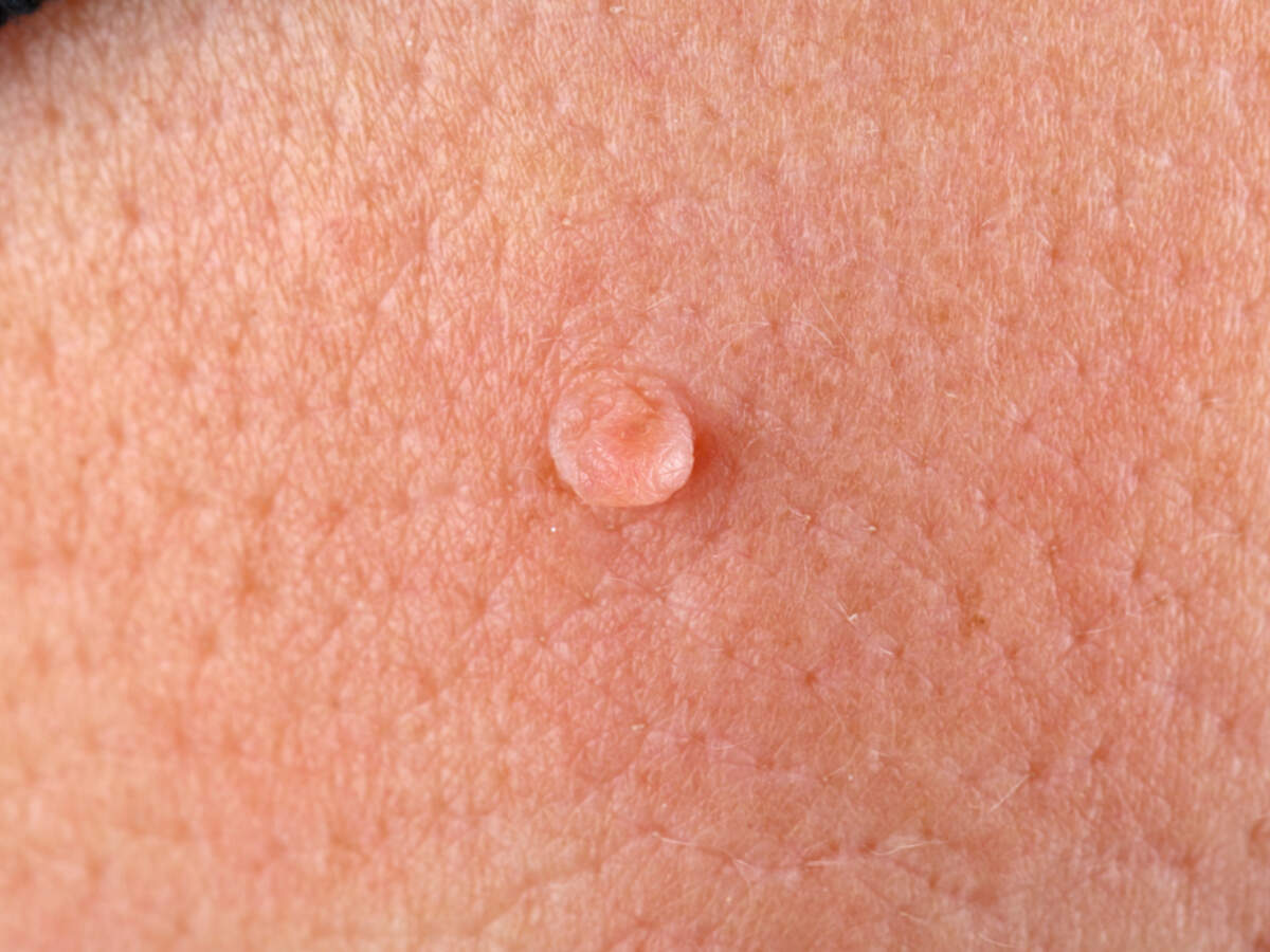 how to get rid of warts on neck