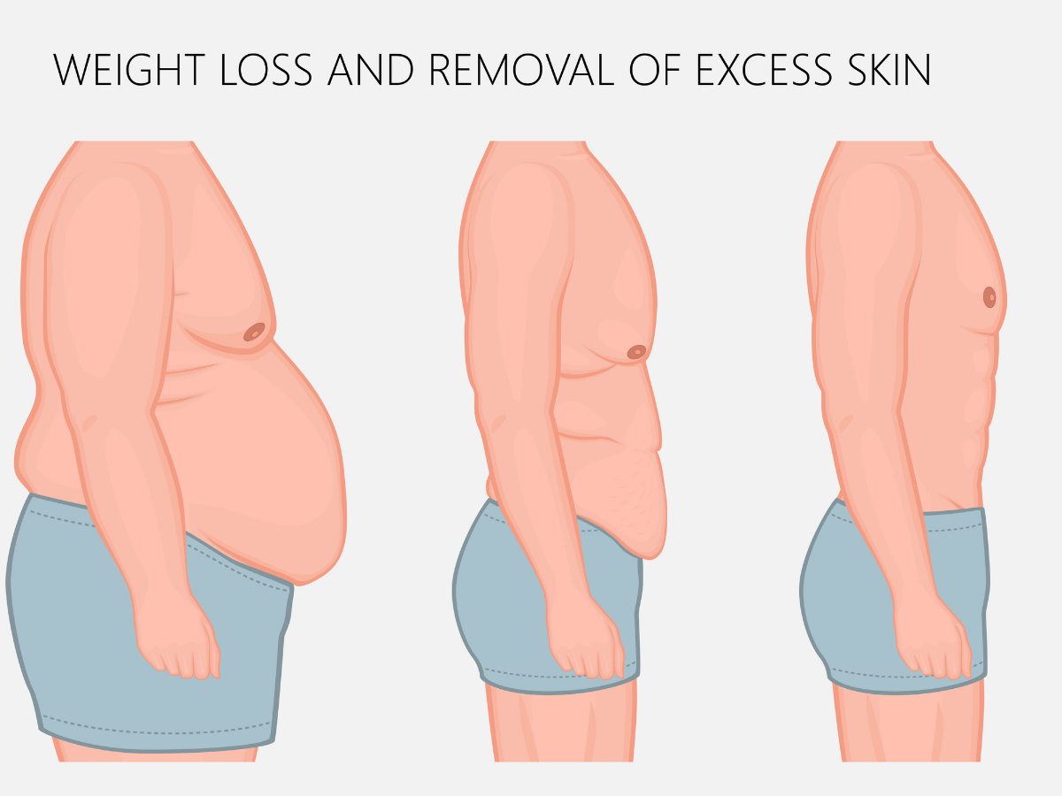 Tighten Loose Skin After Weight Loss  How to get rid of excess skin after  weight loss?