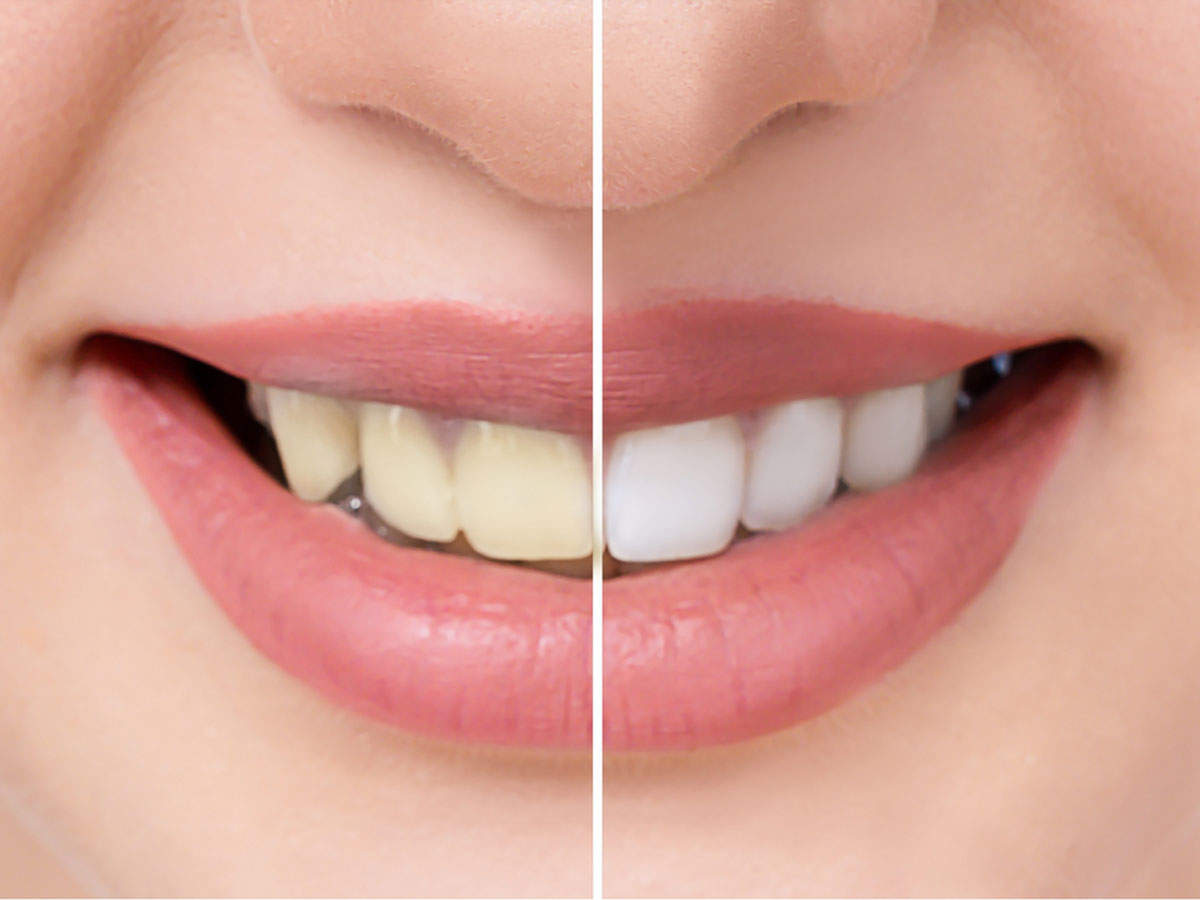 How To Whiten Your Teeth With Common Kitchen Ingredients