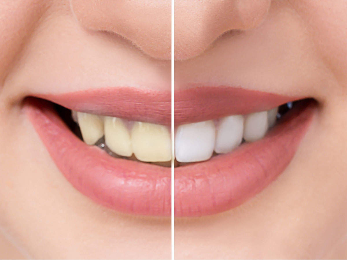 How to whiten your teeth with common kitchen ingredients The