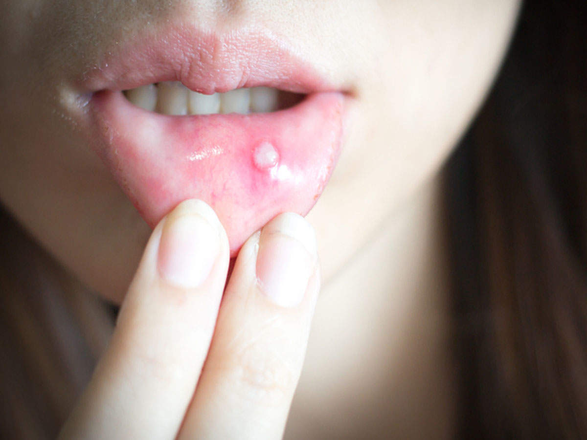 how-to-get-rid-of-tongue-blisters-canker-sores-top-ten-remedies-for