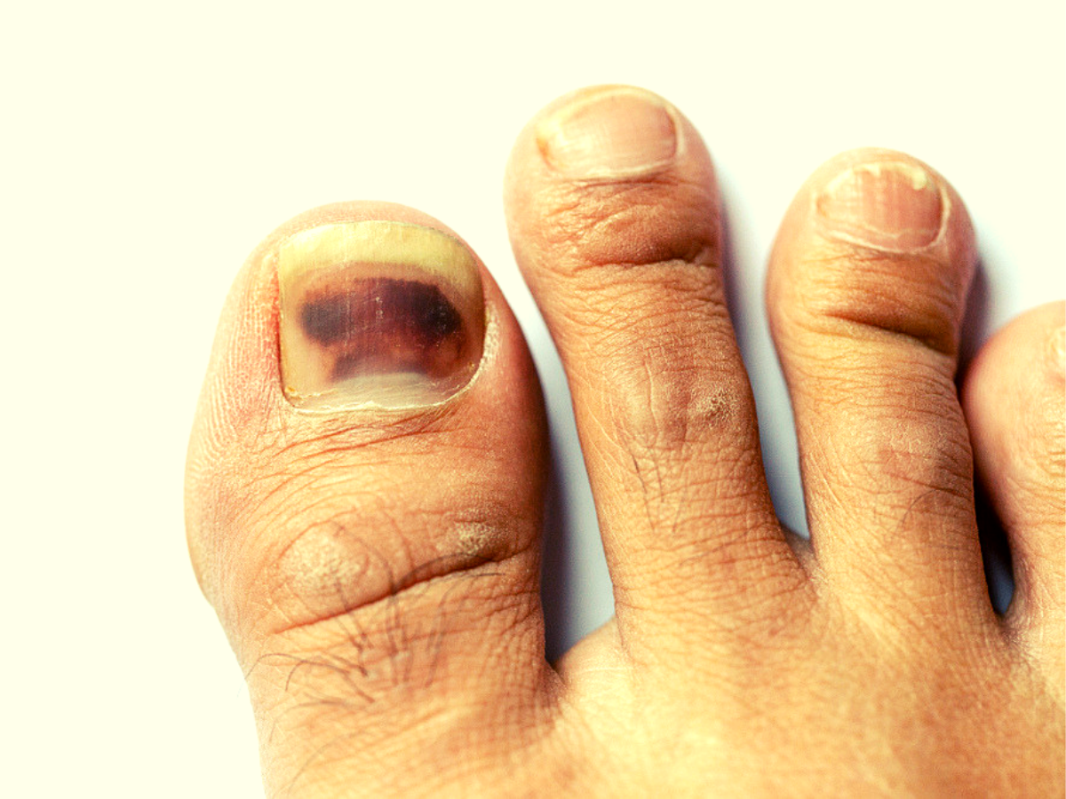 melanoma-under-toenail-pictures-black-spot-nail-melanoma-pictures