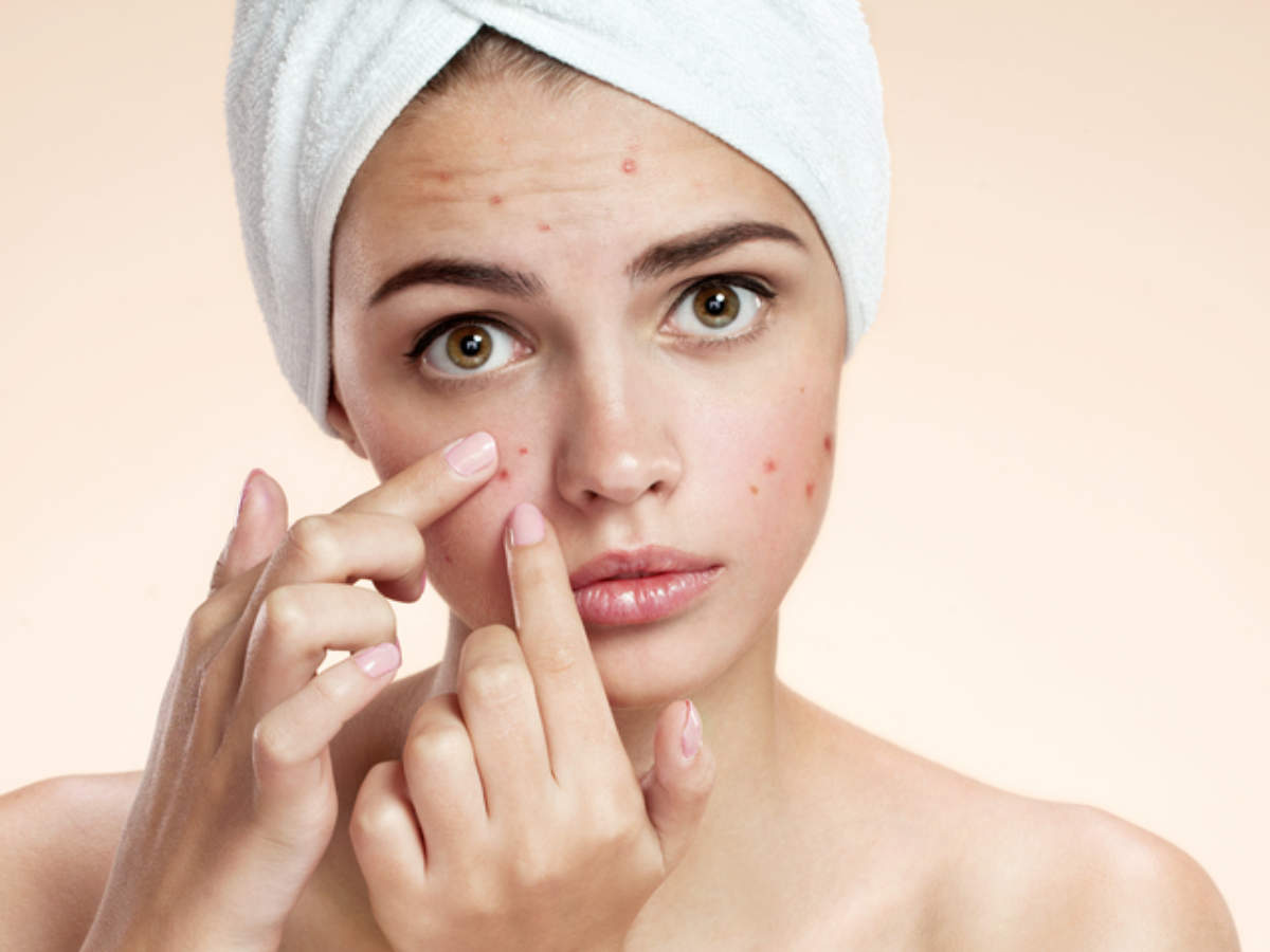 Healthy Habits to Prevent Acne: 5 Daily Habits that Can Prevent Acne