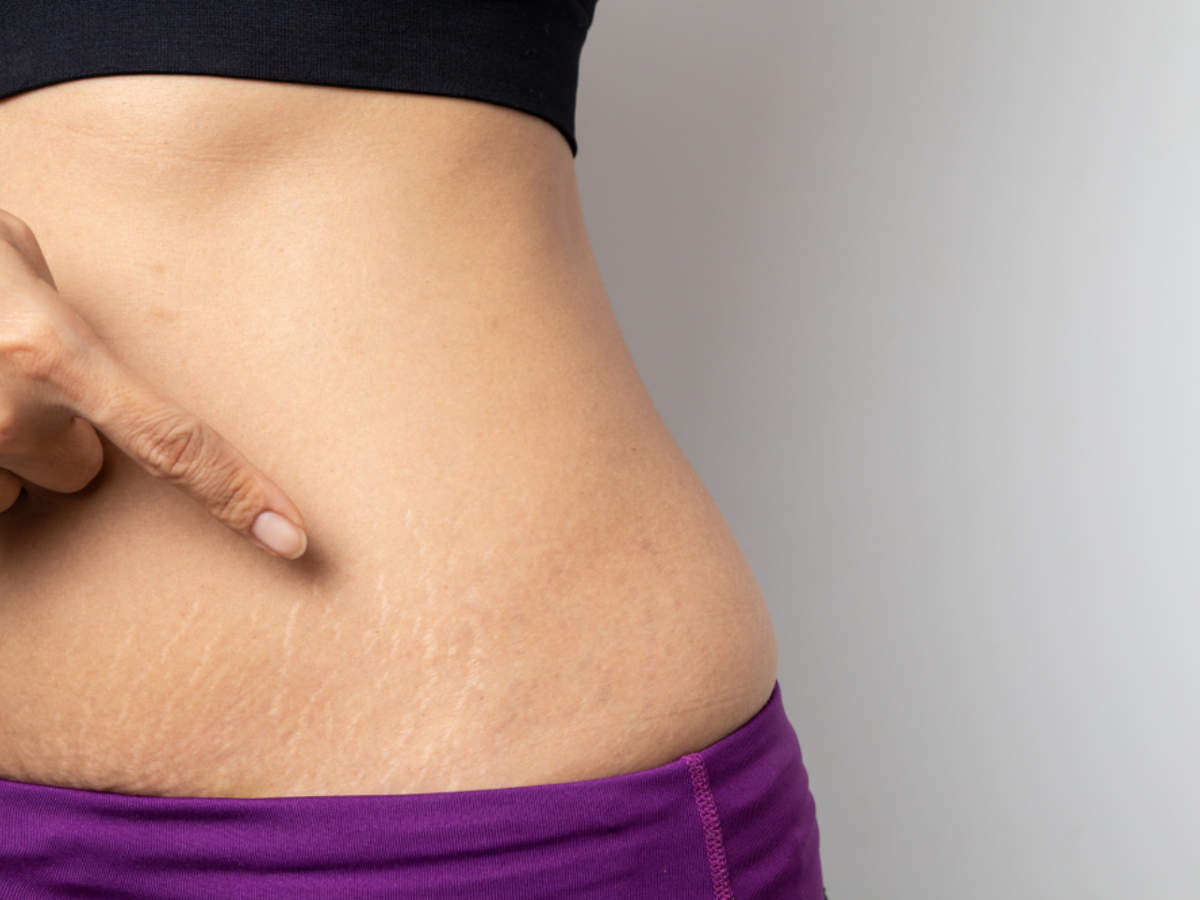 How can you prevent stretch marks while losing weight?