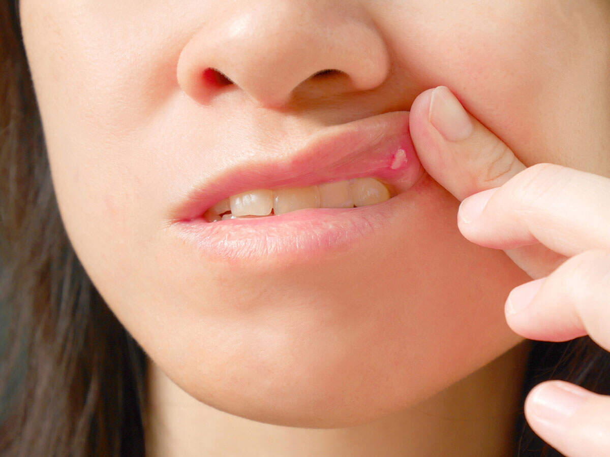 are mouth turmeric How helps ... ulcers? What mouth in treating