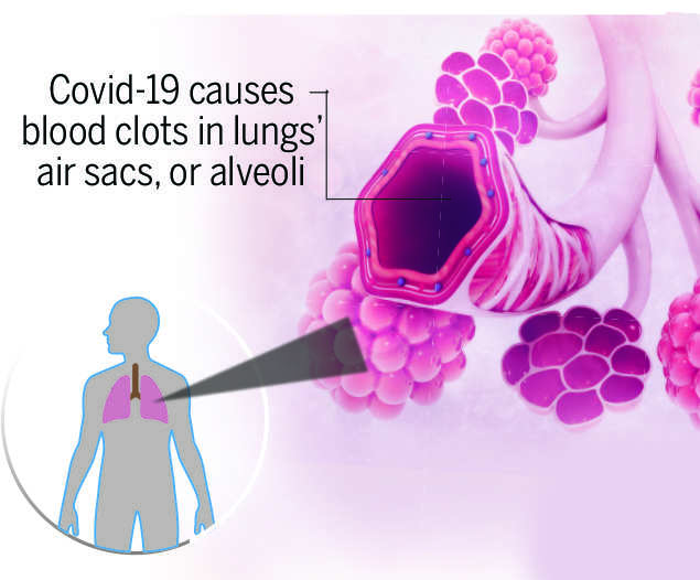 How Covid-19 attacks our lungs - Times of India