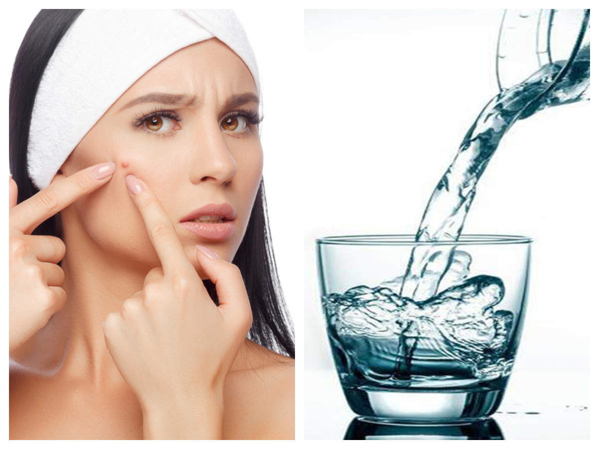 Drink water to get rid of those pimples! | The Times of India