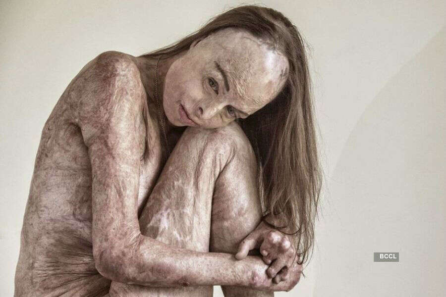 Beauty queen who suffered 85% burns in house fire poses naked for a powerful portrait