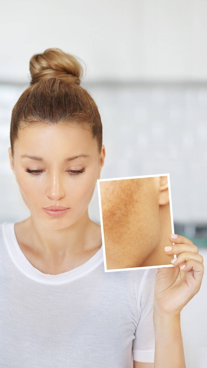 Home Remedies To Get Rid Of Dark Spots Times Of India