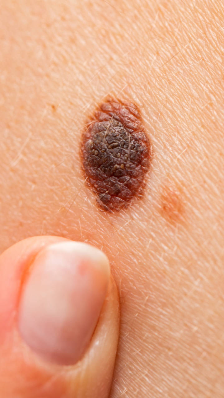 How to Remove Moles: Causes, Home Remedies & Treatments