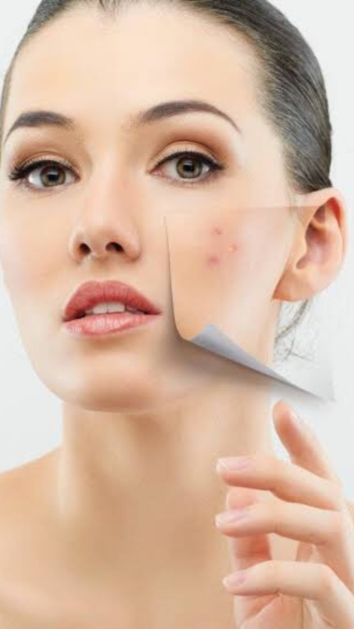 Beauty Tips For Clearing Acne Times