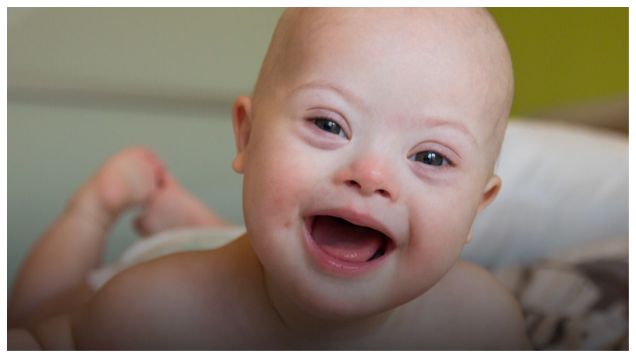 Study suggests risk of leukemia higher in children with Down syndrome(00)