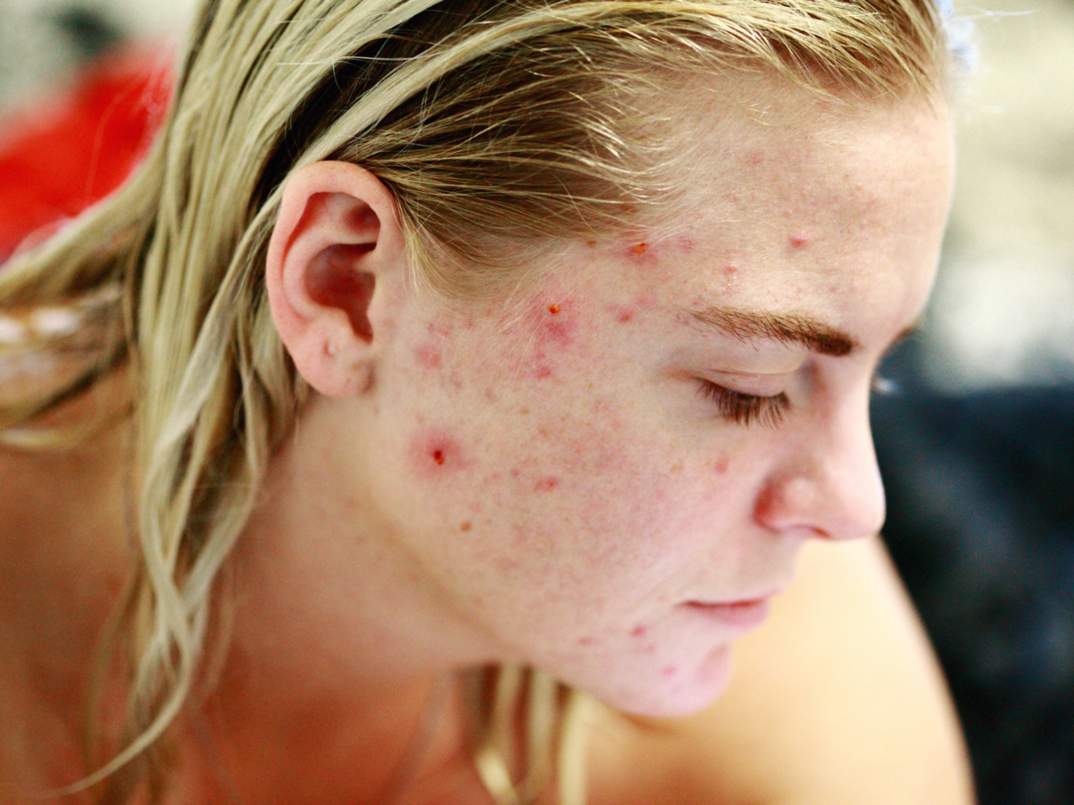 Aspirin For Acne And Scars: Is aspirin really effective on acne and scars?