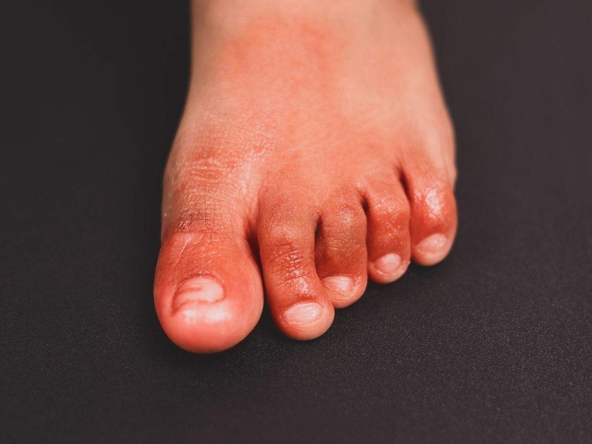 What is Covid toes? All you need to know