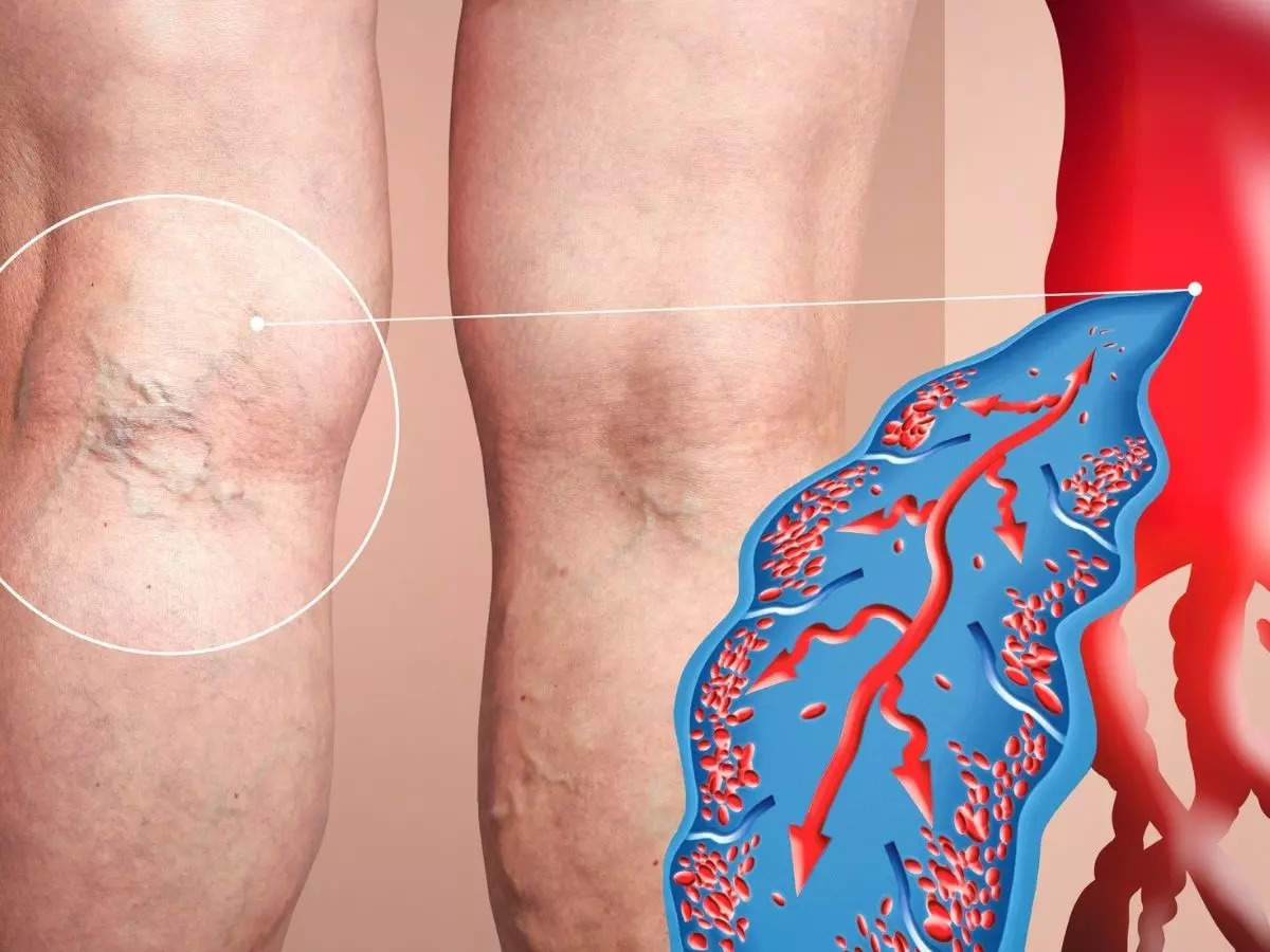 Blood Clot In Leg Symptoms Deep Vein Thrombosis DVT Signs Of Blood 