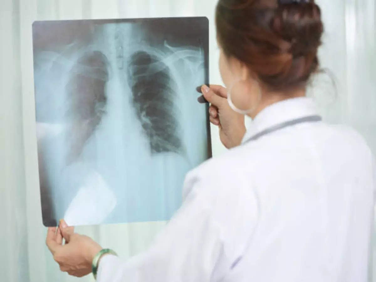 Doctors Bust Myths Around Tuberculosis - Times Of India