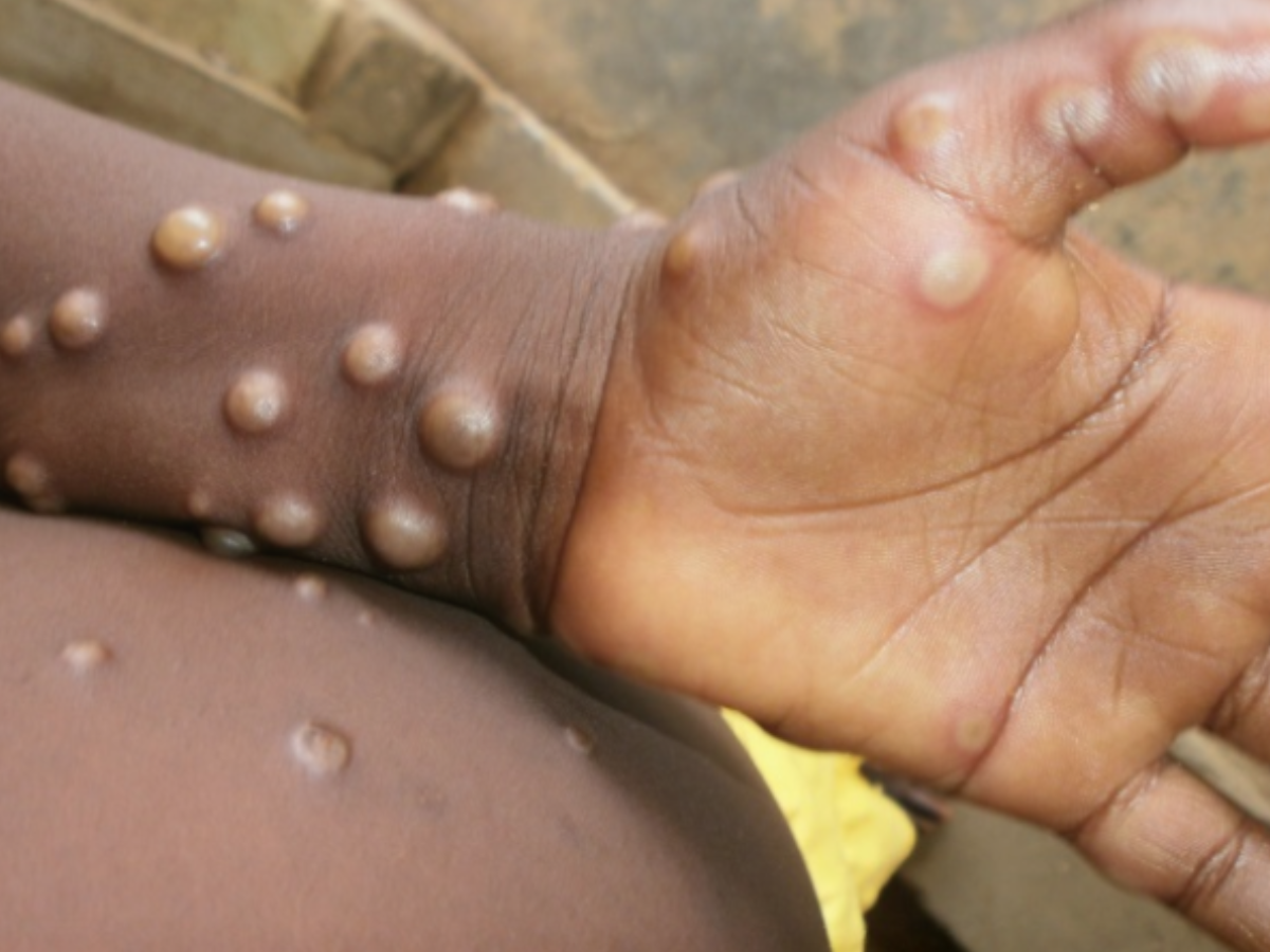 Monkeypox virus: Know what it is, how it spreads, what causes it | The  Times of India