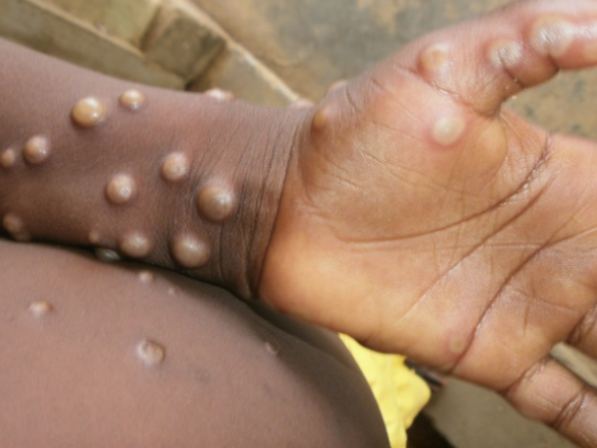 Here Are Three Signs You May Have Monkeypox