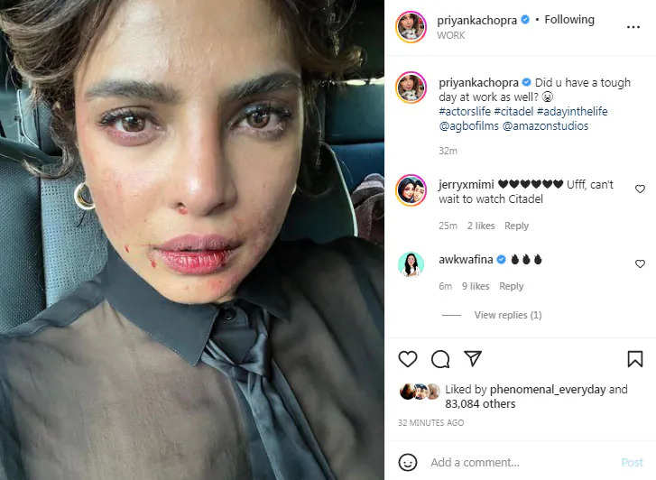 Fans ask 'Are you ok?' after Priyanka Chopra shares a photo of her bruised face from the sets of 'Citadel' - Times of India