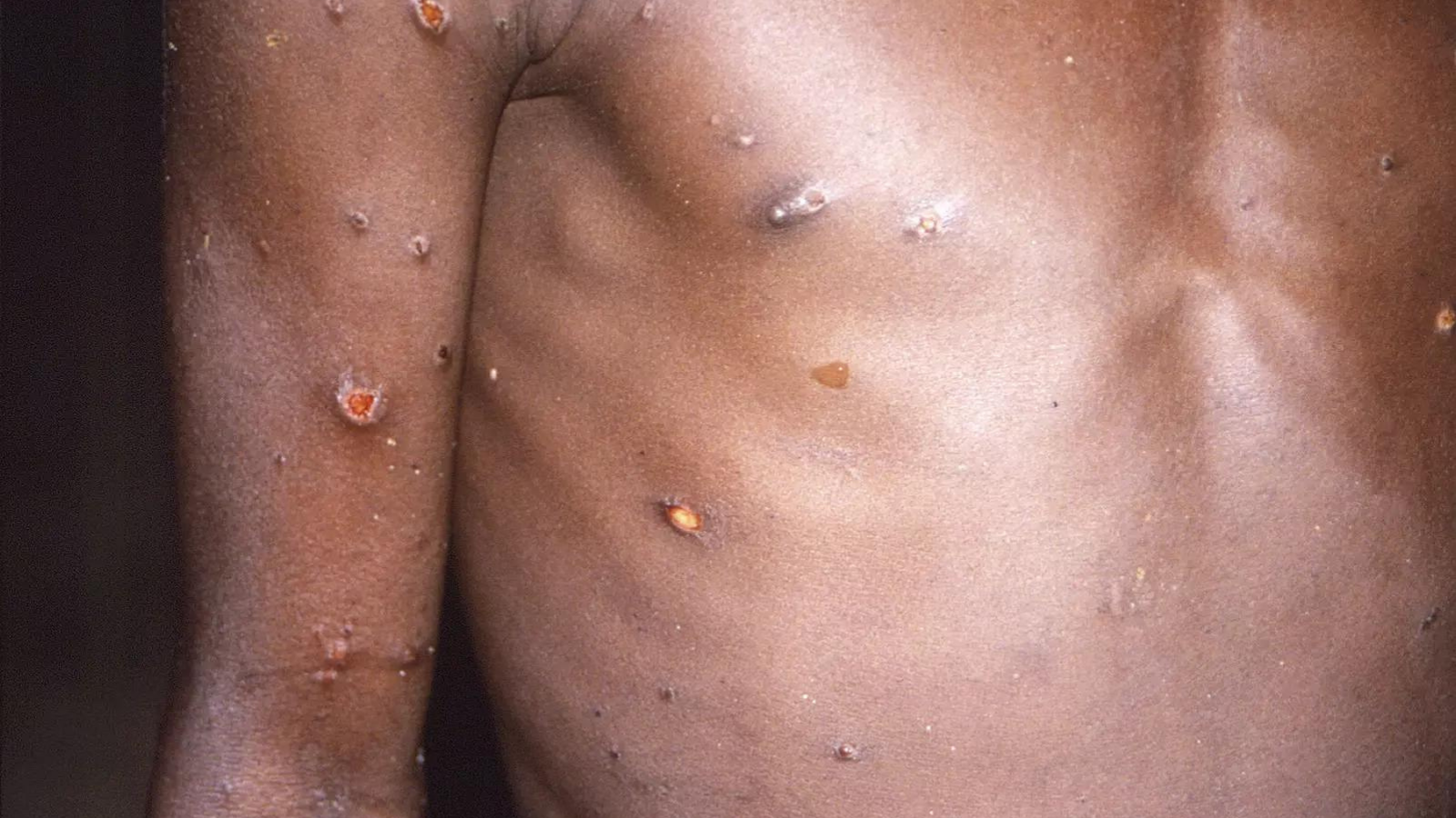 monkeypox US confirms 9 monkeypox cases across 7 states(00)