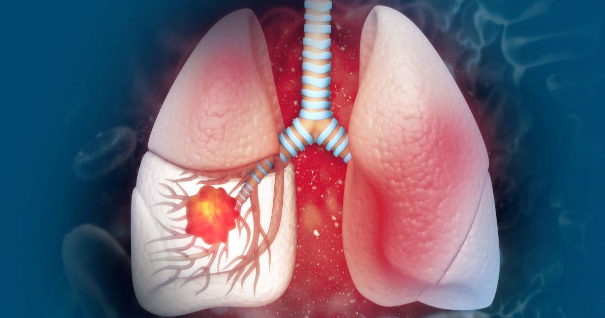 Lung cancer symptom: Palpitations may signal a tumour is putting pressure on the heart