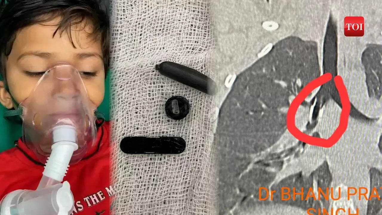 Whistle stuck in a windpipe of a 5-year-old girl