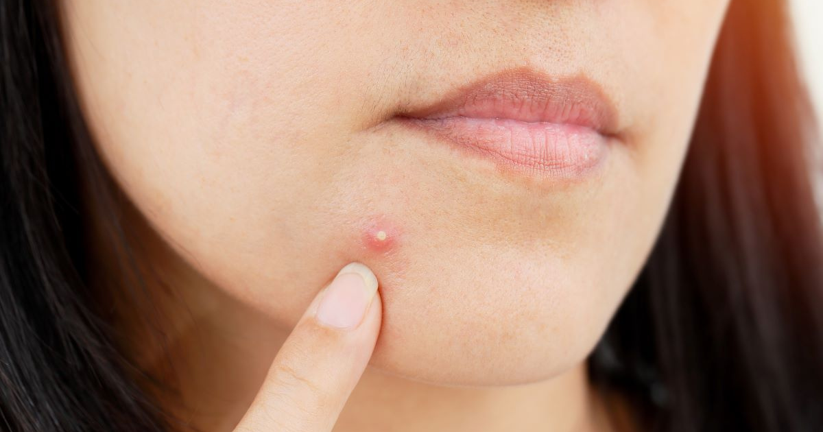 Skin Cancer Symptoms: This is the No. 1 skin cancer symptom people ignore,  doctors say