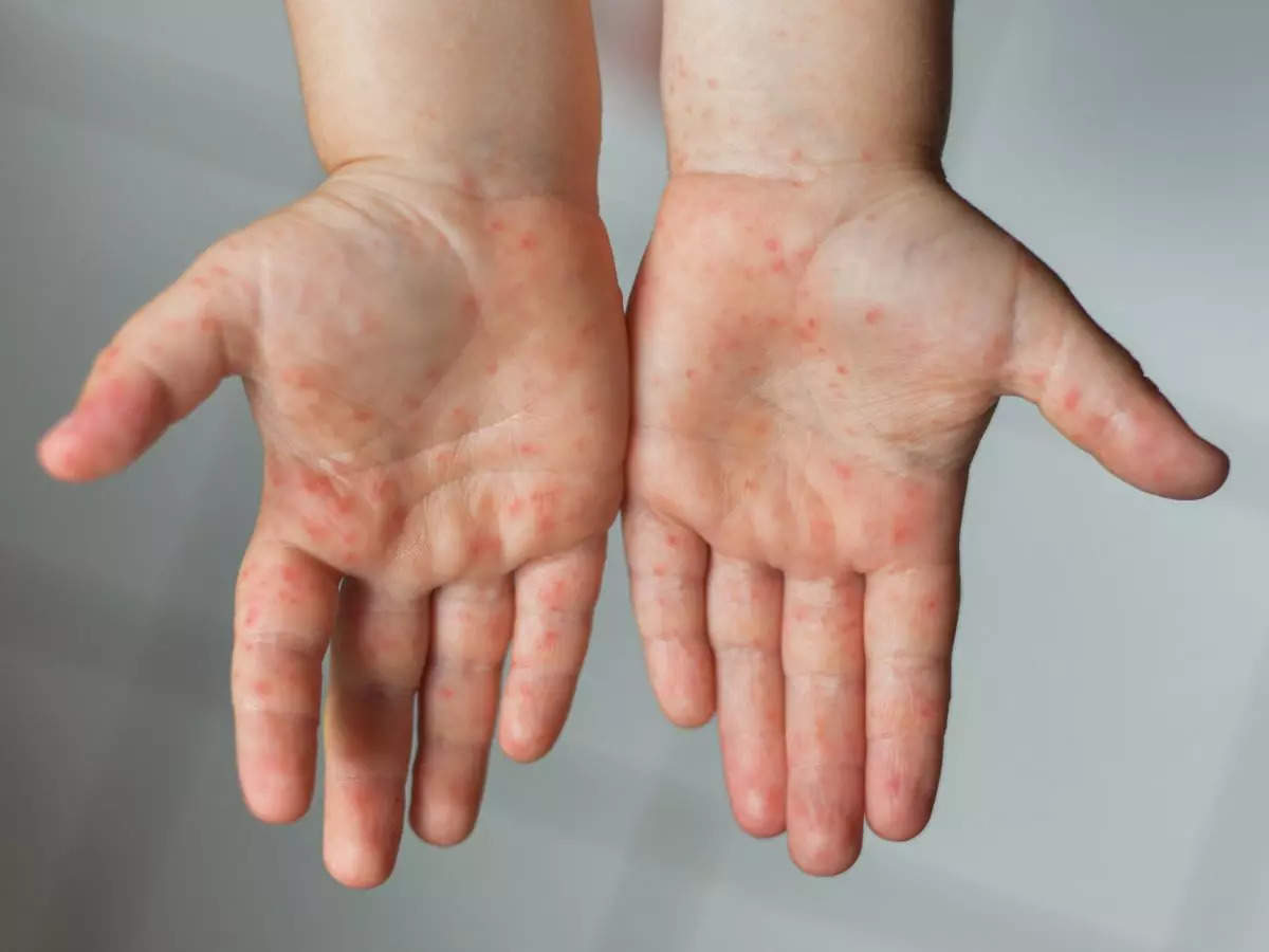 Monkeypox Vs. Tomato Flu: How To Differentiate Between The Two?