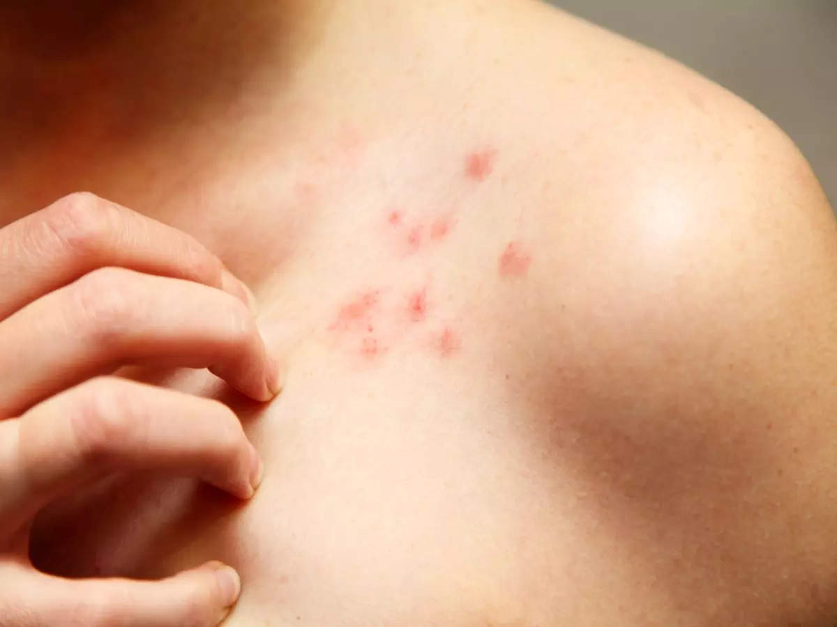 Coronavirus: Chickenpox-like rash and other less talked about troubling  symptoms