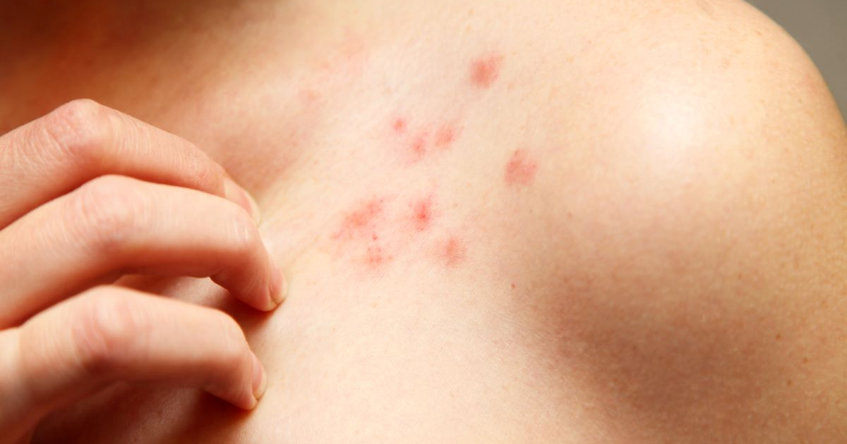 What Do Chicken Pox Look Like Link Between Chickenpox And Shingles: