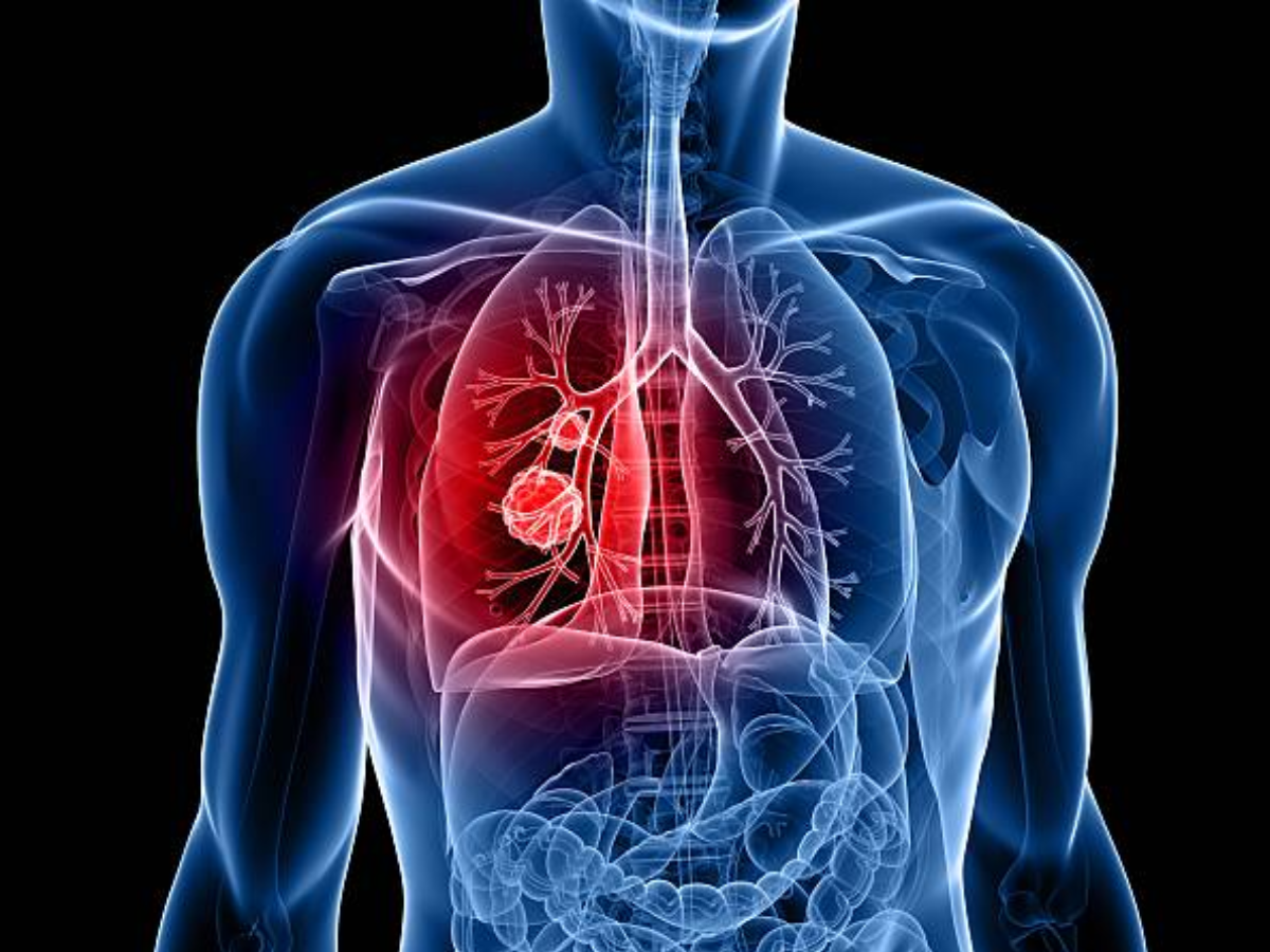 Covid, pneumonia may damage lungs: Signs, precautions
