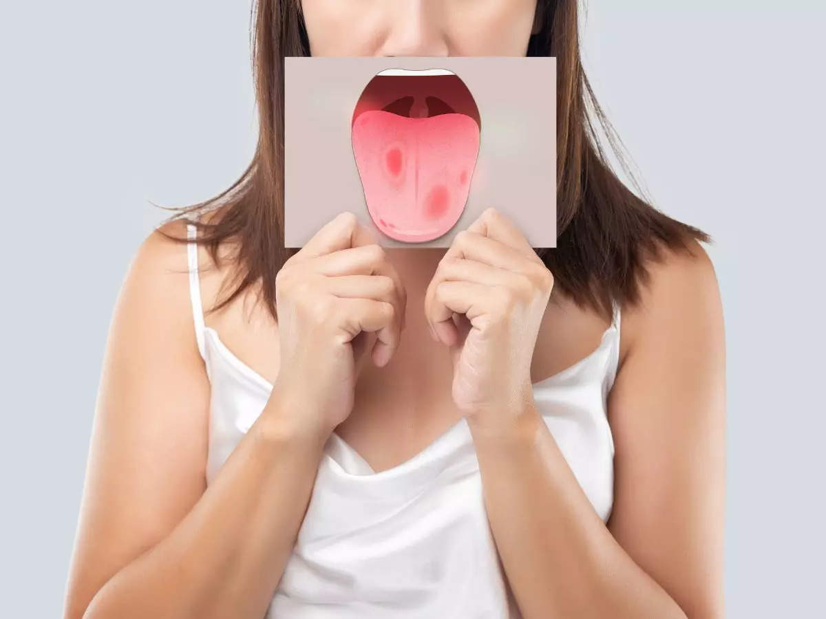 Vitamin B12 deficiency: This deficiency sign in your mouth is called  lingual paresthesia | The Times of India