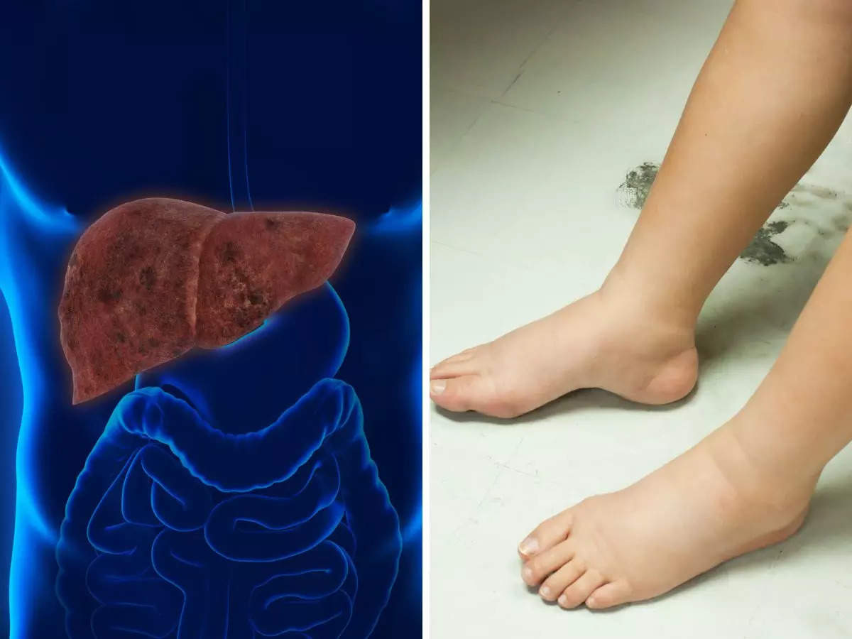 Liver Failure: ​Watch Out! Cracked Heels, Itchy Feet Signal Liver