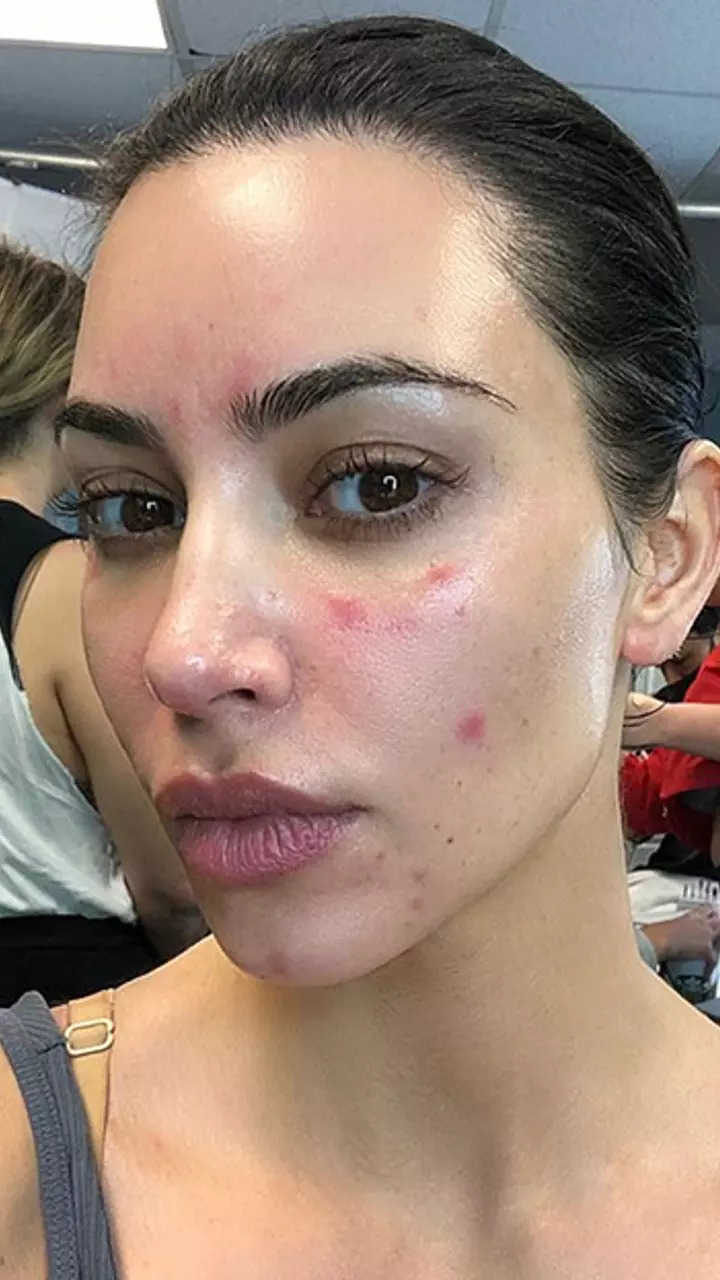 cameron diaz acne scars