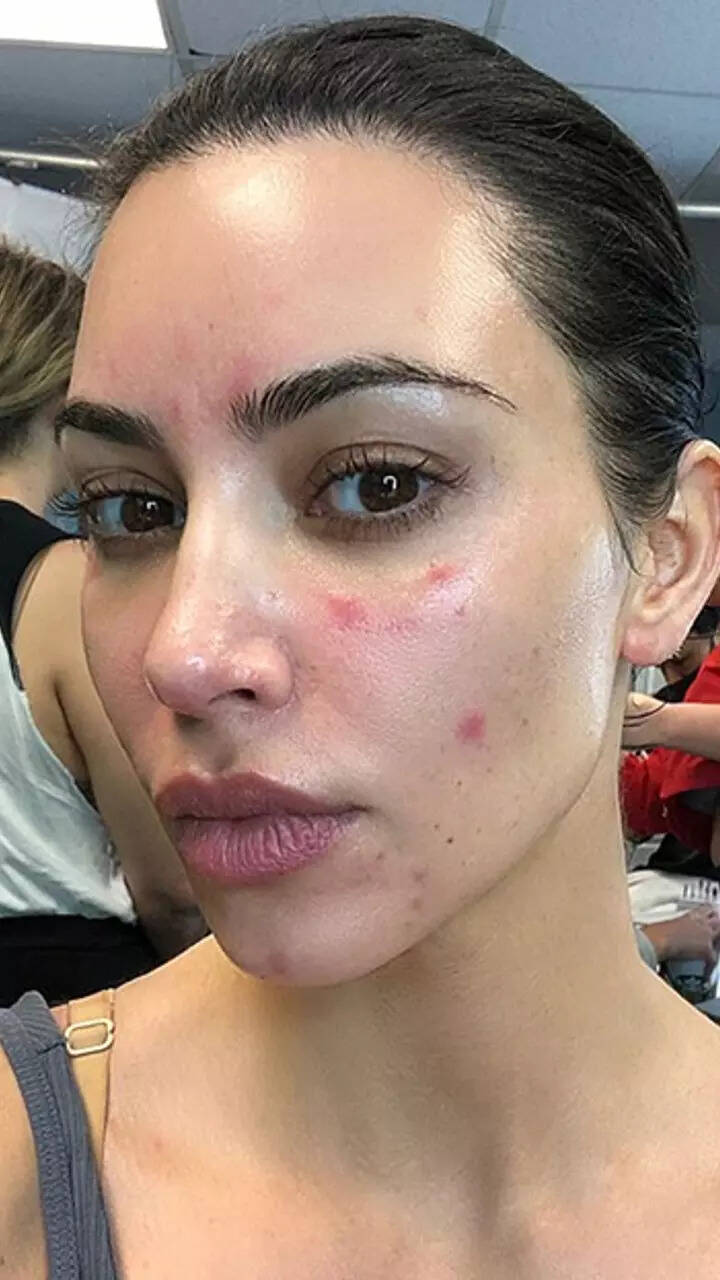 Bad Skin Example Celebrities With Bad Skin 2013 Photos: What Actresses Look Like